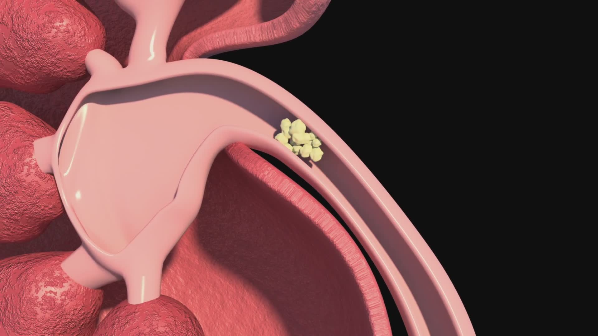 Understanding kidney stone formation and effective treatment options