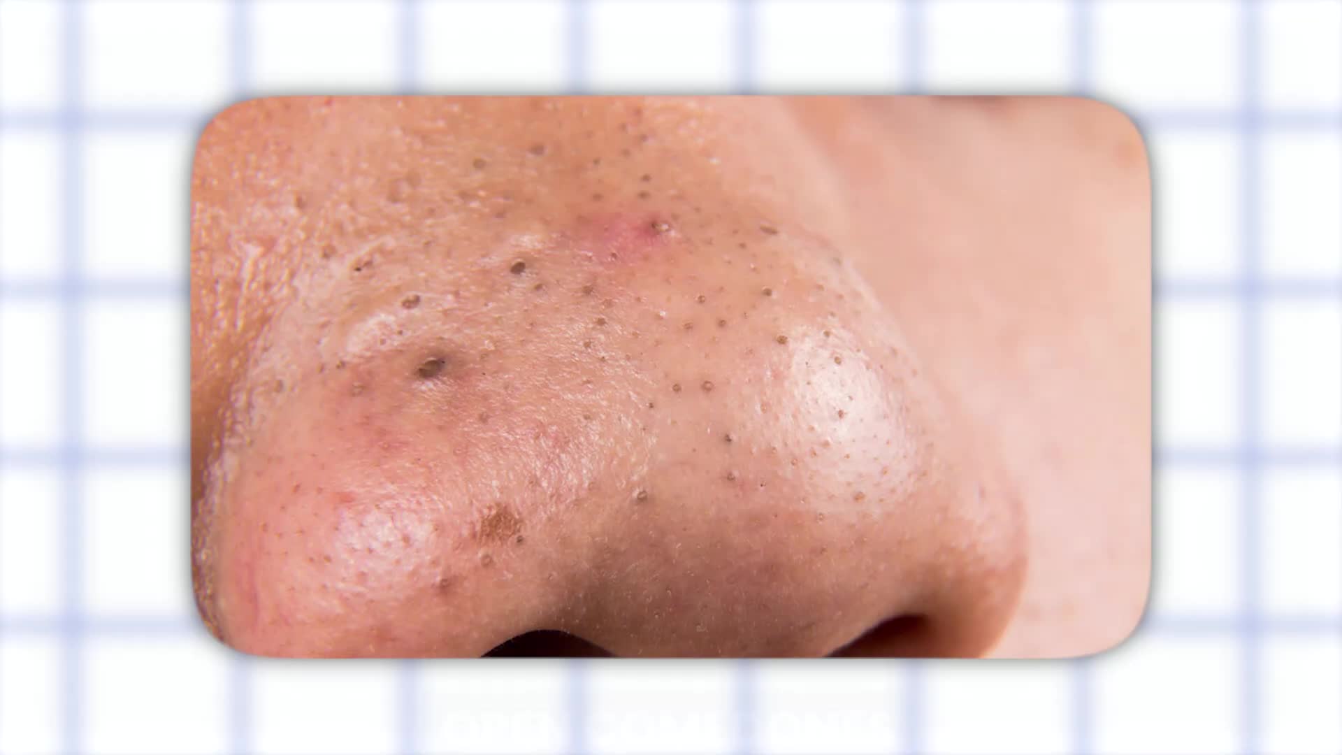 Why your blackheads keep coming back hidden causes and fixes explained