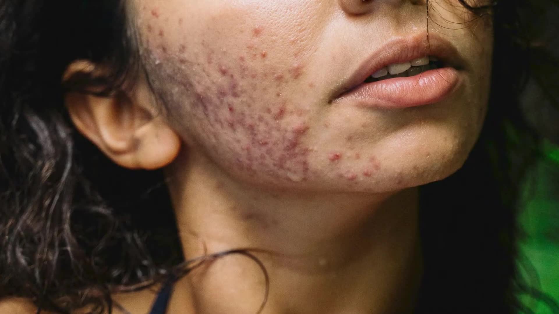 Accutane what to know before during and after treatment dermatologist guide