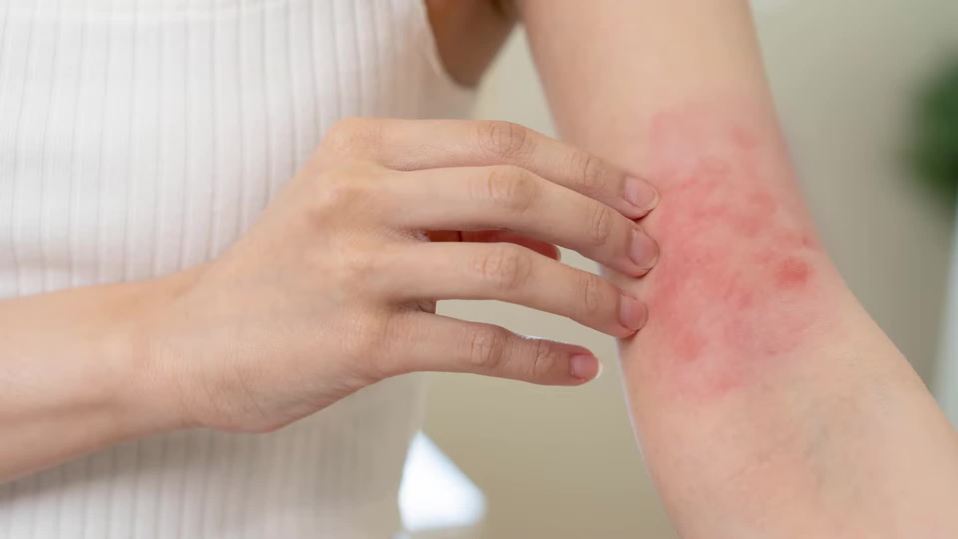 Best eczema remedies and products to use according to dermatologist