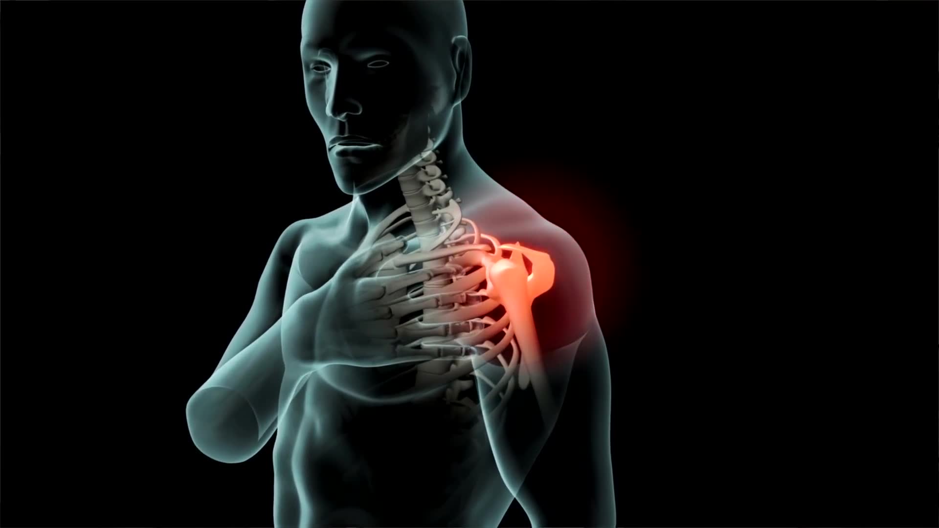 Joint degeneration requiring total shoulder arthroplasty