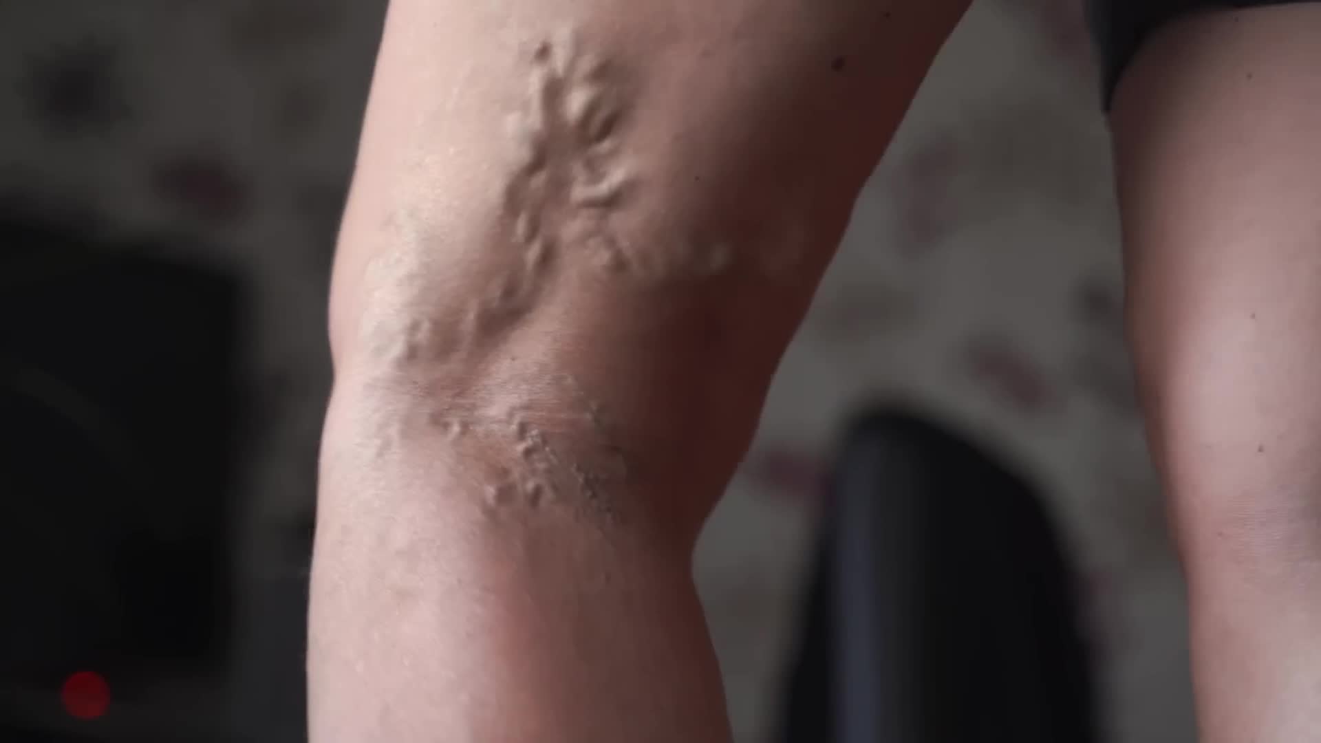 Treatment options for enlarged twisted superficial leg veins