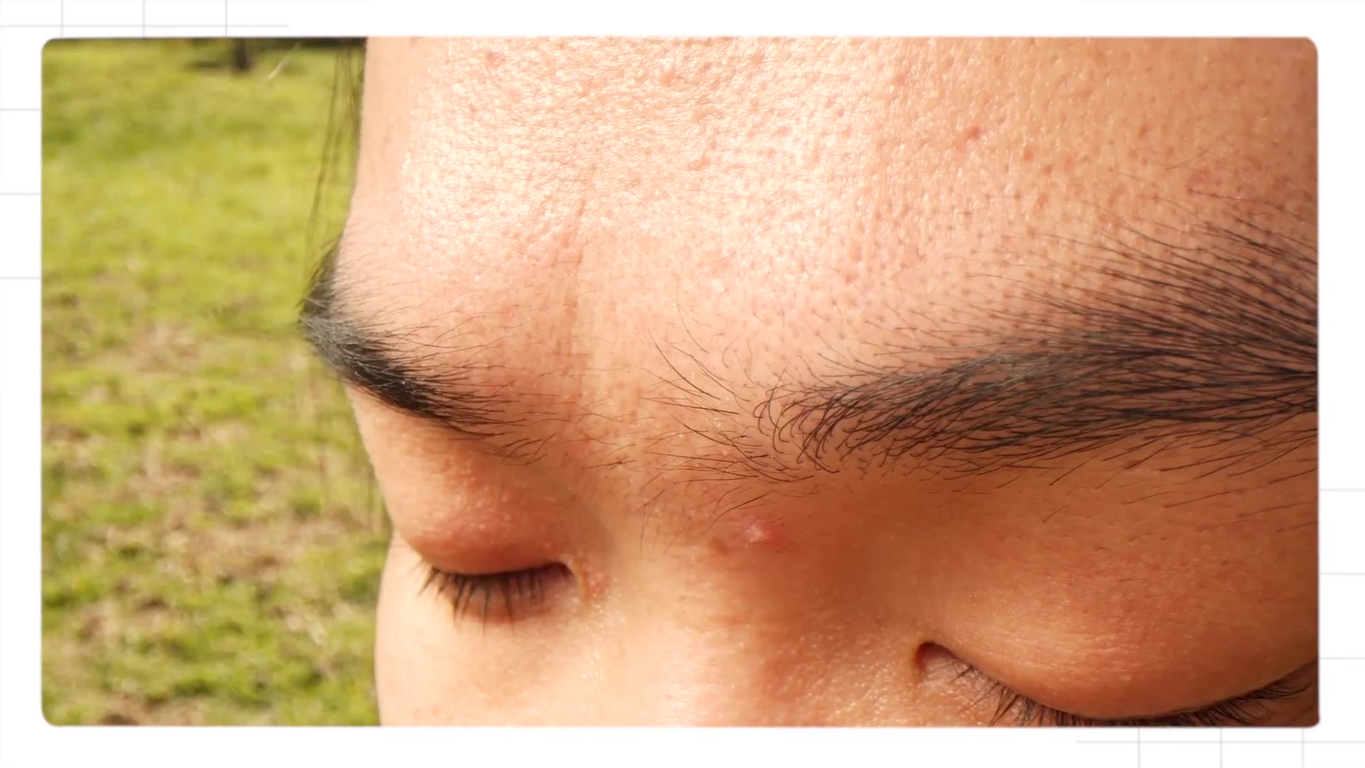 Complete breakdown of acne varieties and what causes each type