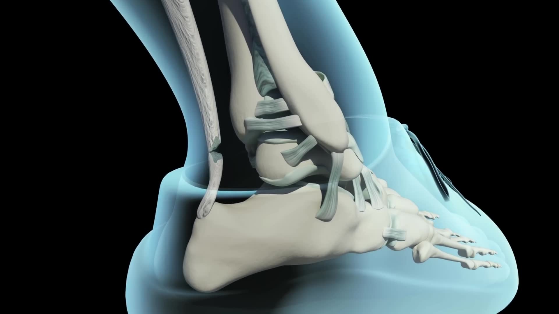 Ruptured Achilles tendon: do you actually need surgery or can it heal on its own?