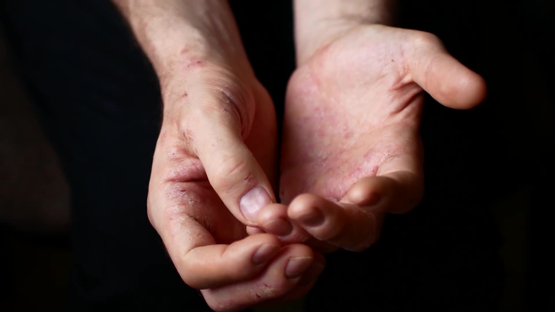 Comprehensive psoriasis management approaches from skin specialist