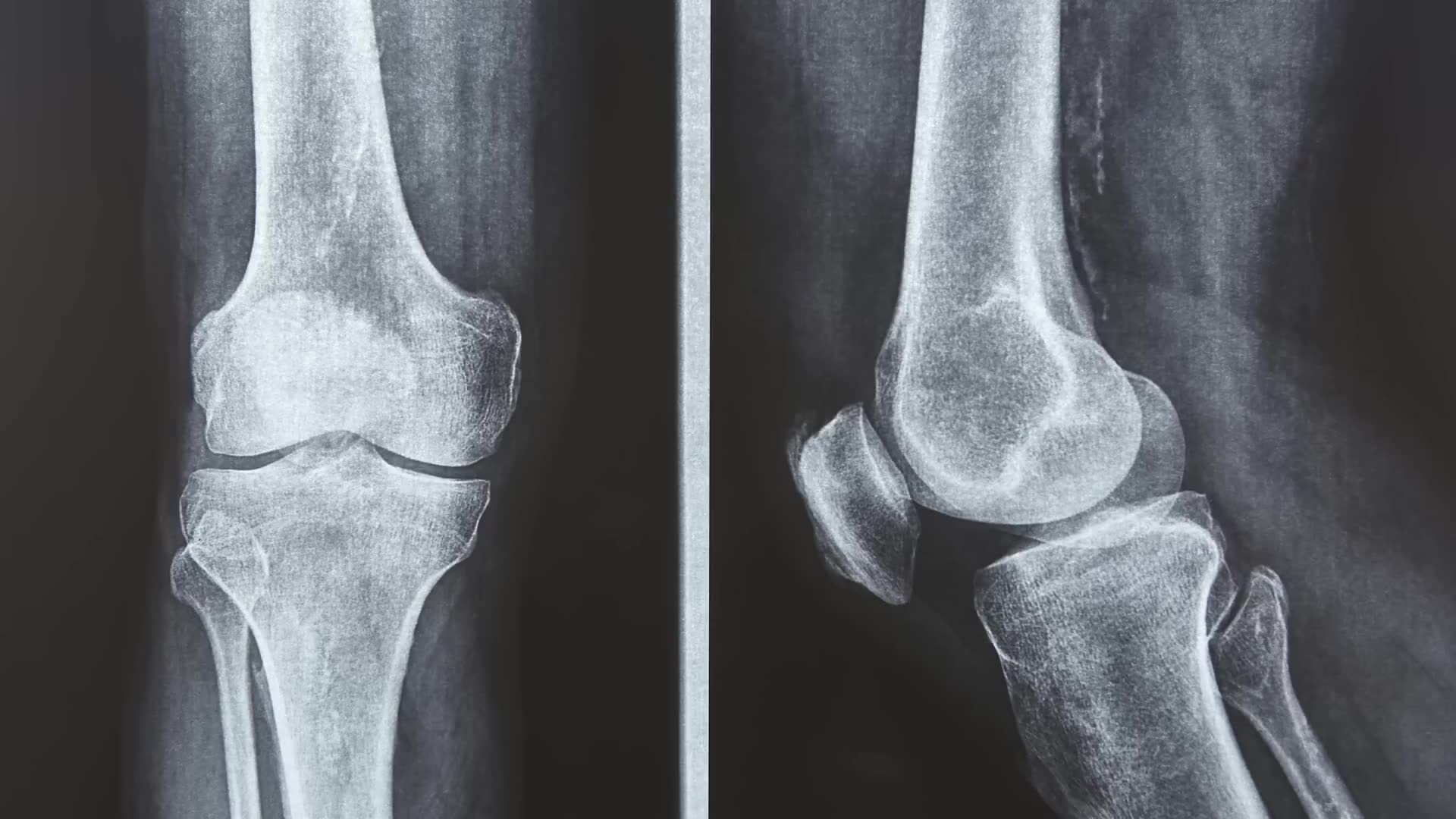 Knee x-rays 101. how to interpret your x-ray report