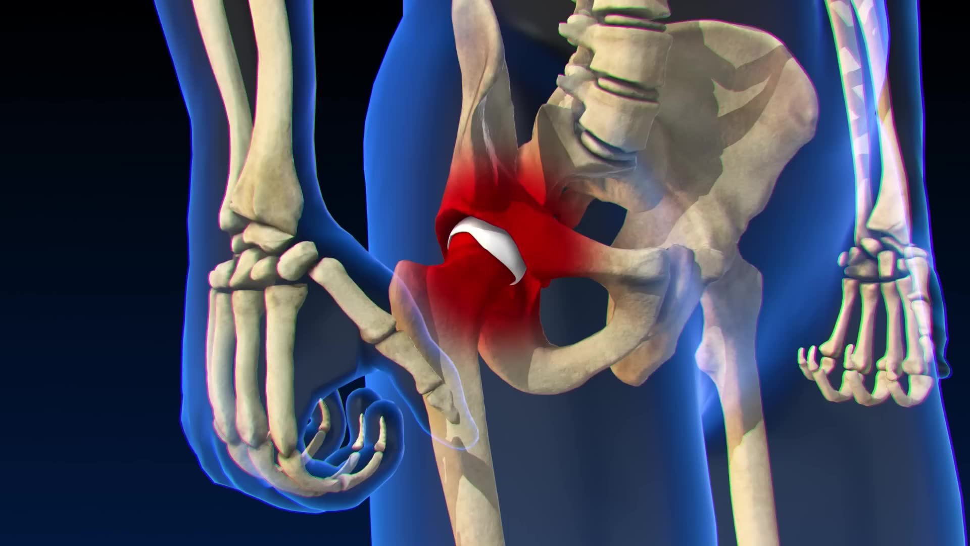 What really happens during hip replacement surgery