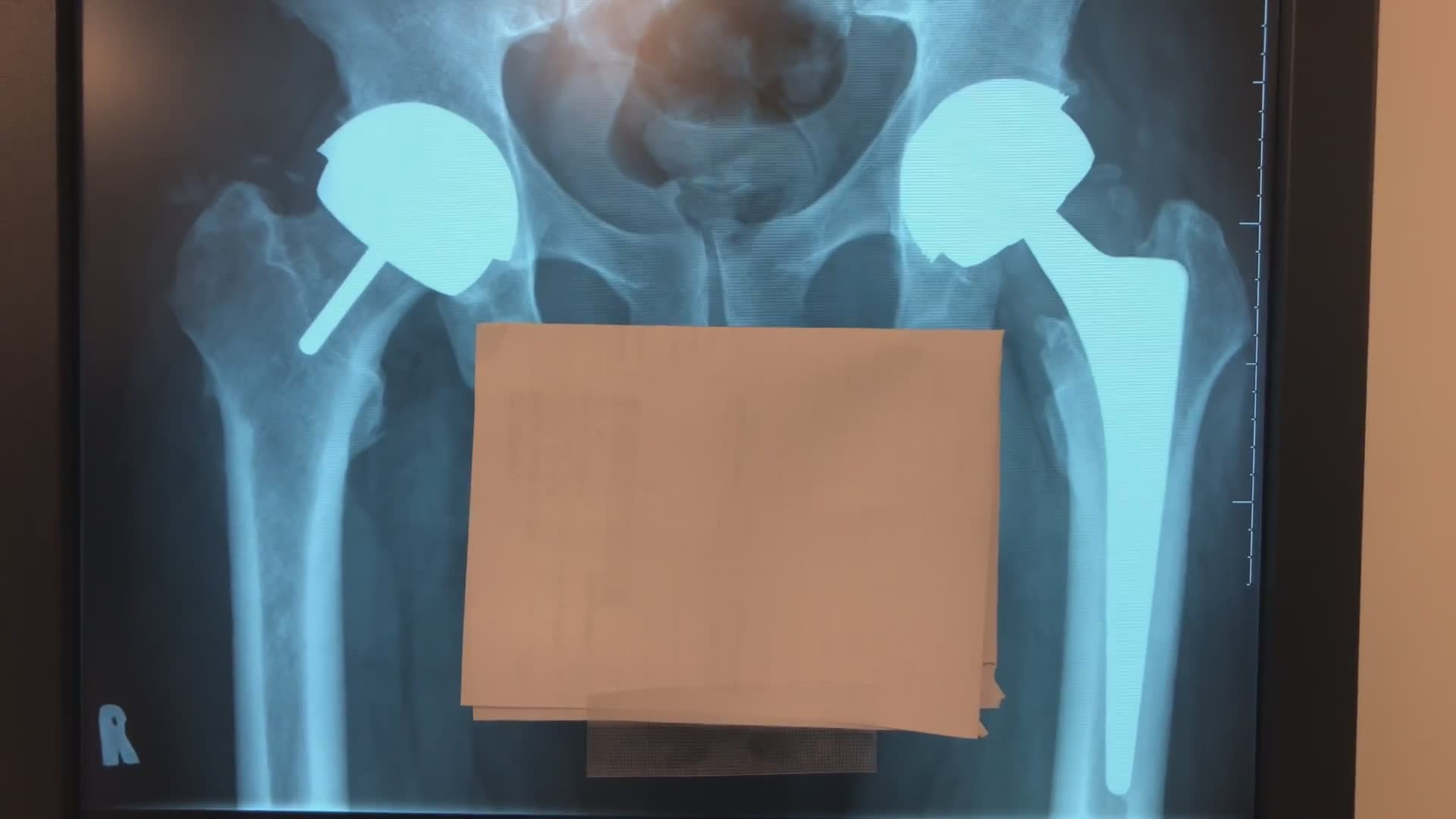 Understanding difference between hip resurfacing and total hip replacement