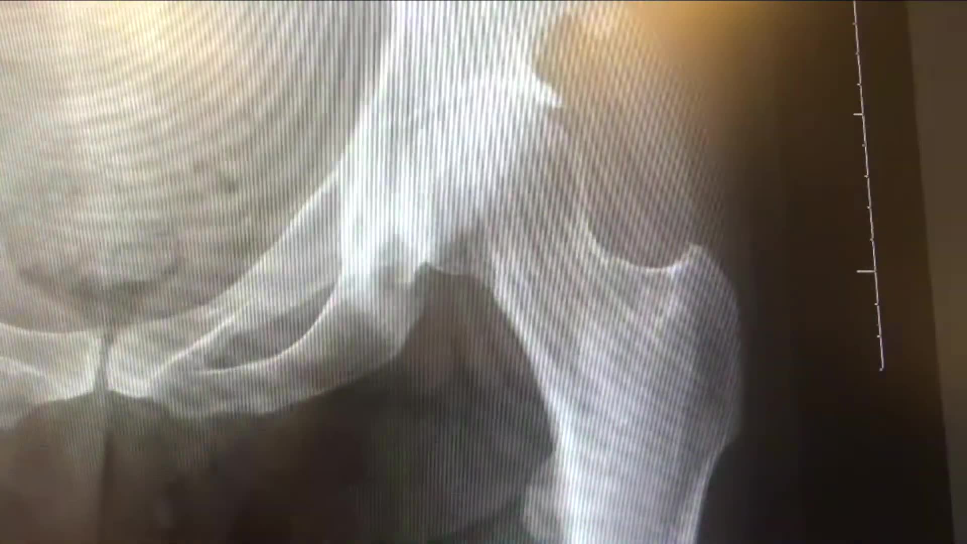 Orthopedic surgeons share what they tell patients about hip dysplasia and developmental delay