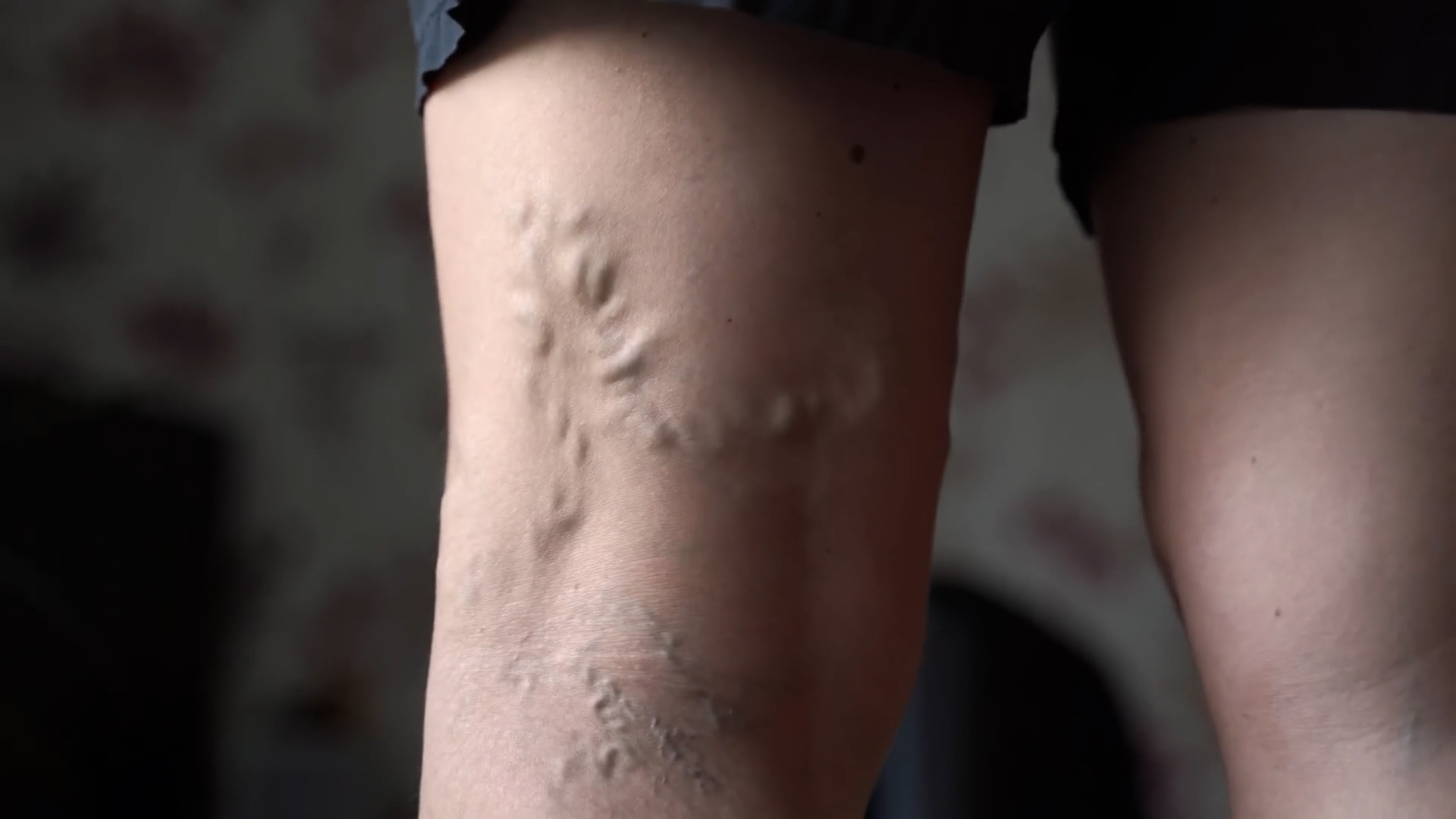 A vascular surgeon explains your real options for treating varicose veins