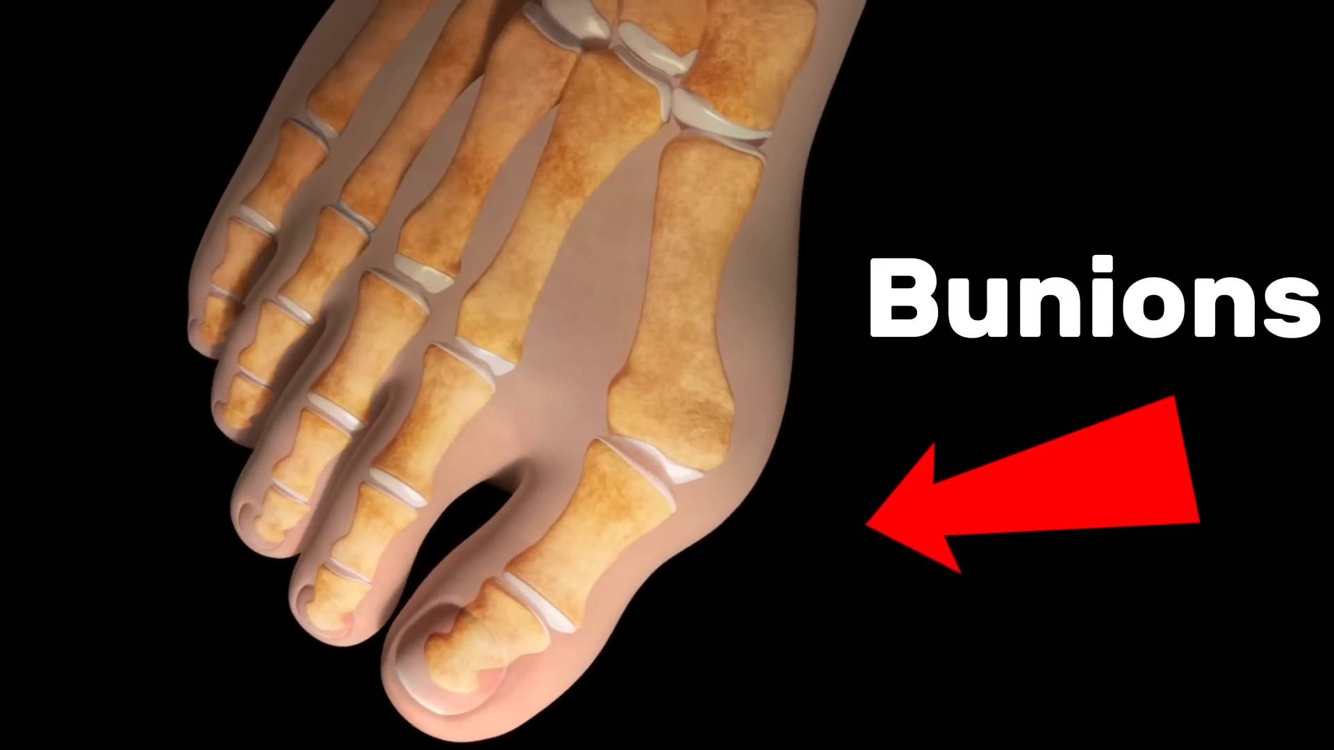 Bunions causes and treatments | Doctors explain